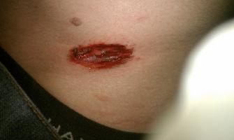 My first Stitches